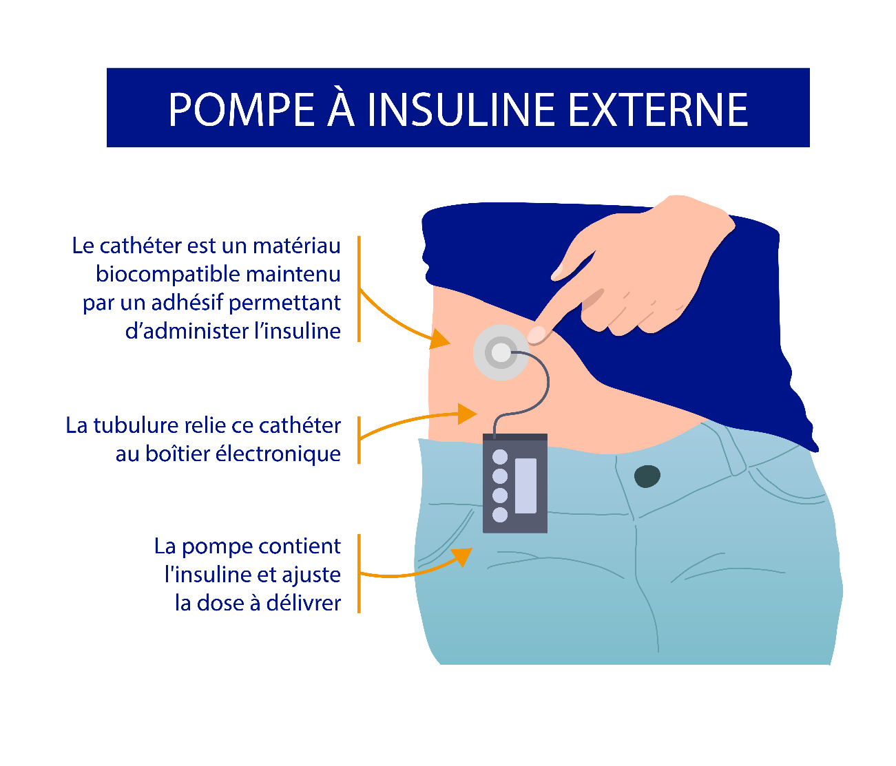 Pompe à insuline 